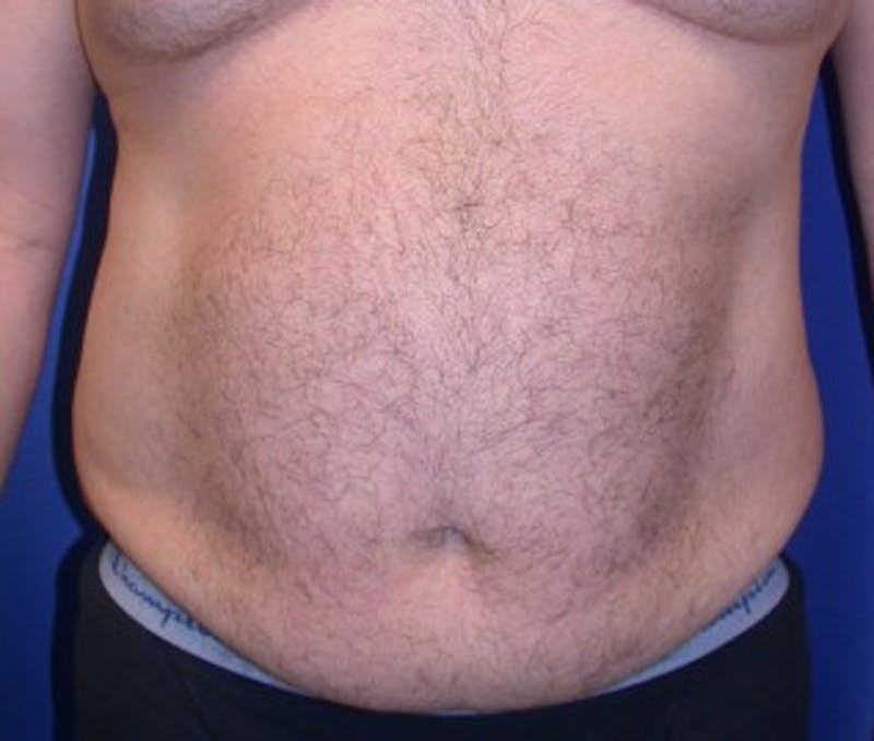 Tummy Tuck Before & After Gallery - Patient 174164460 - Image 1