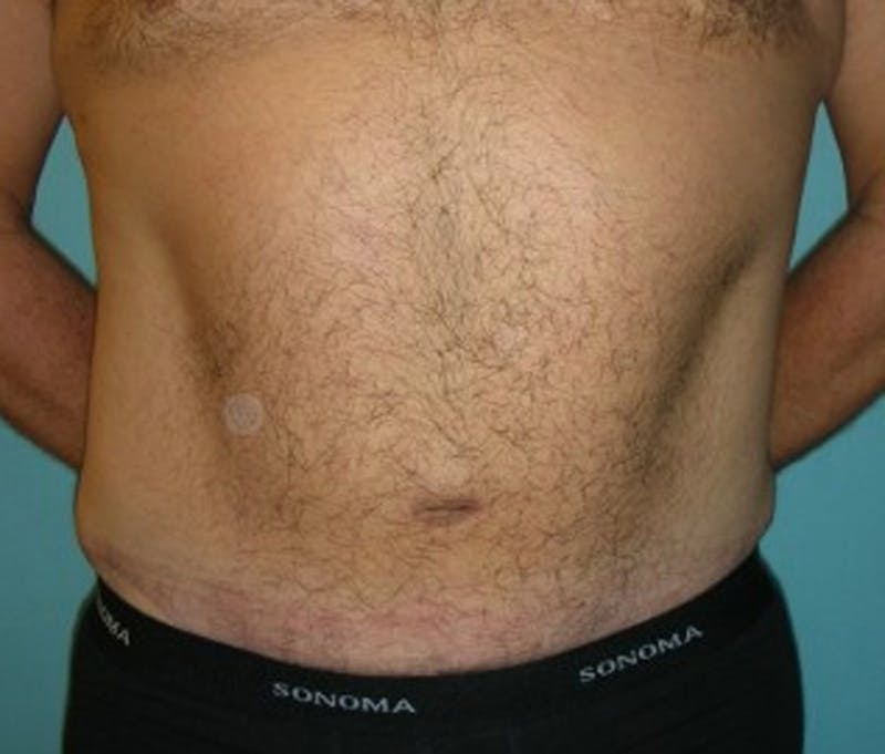 Tummy Tuck Before & After Gallery - Patient 174164460 - Image 2