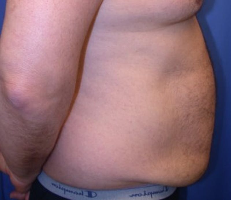 Tummy Tuck Before & After Gallery - Patient 174164460 - Image 3