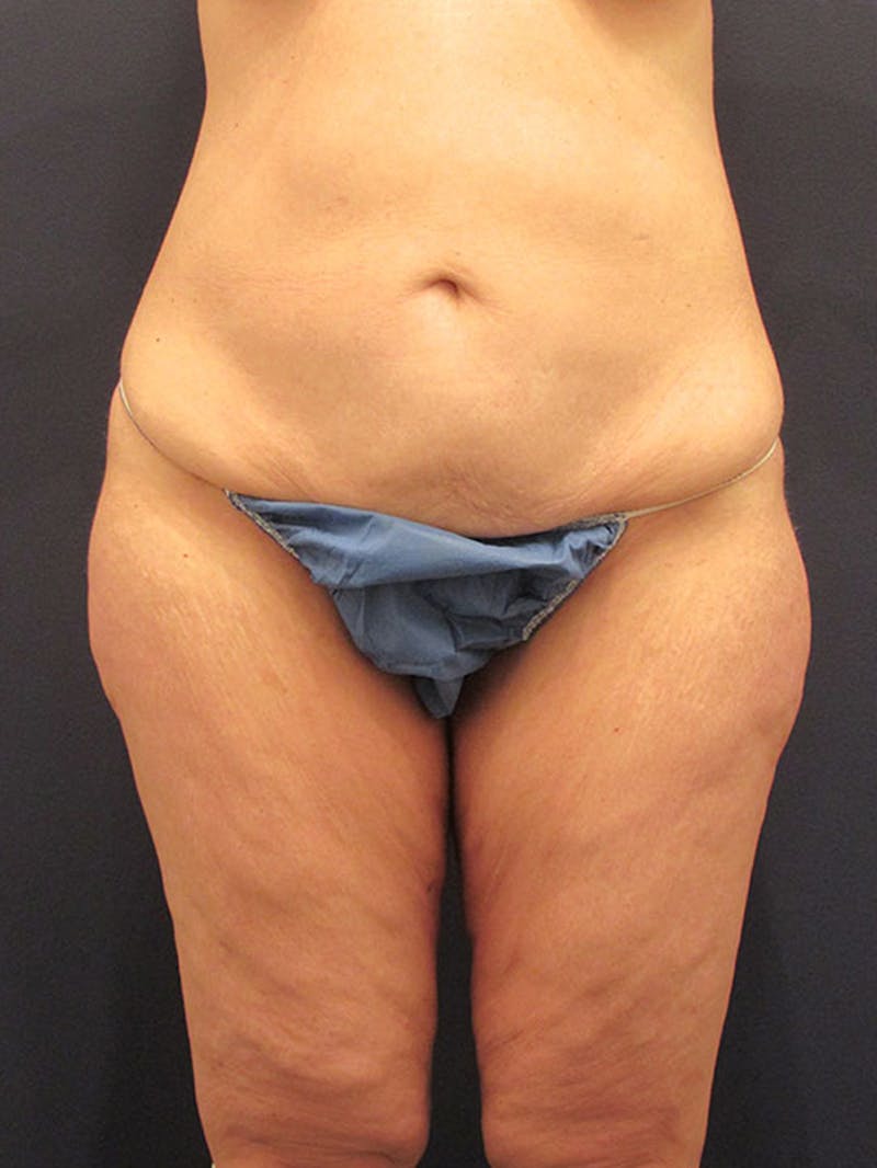 Tummy Tuck Before & After Gallery - Patient 174164465 - Image 1
