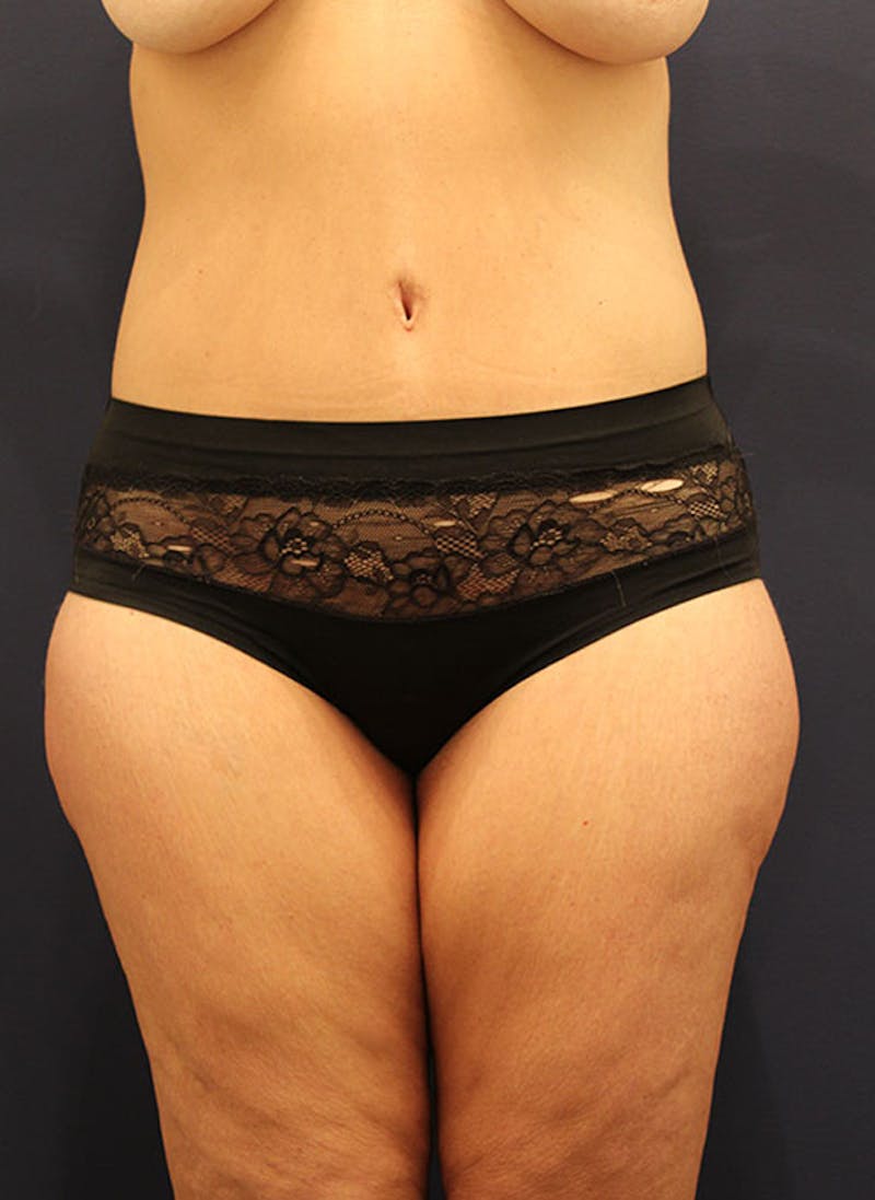 Tummy Tuck Before & After Gallery - Patient 174164465 - Image 2