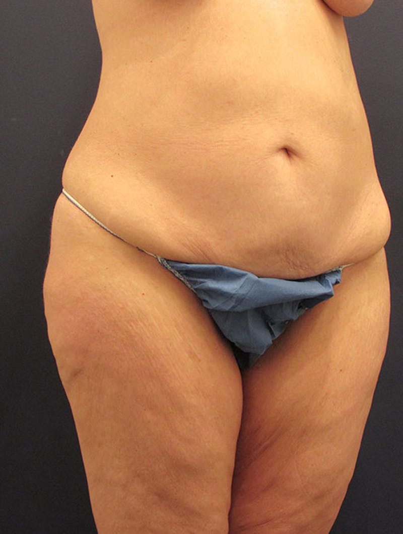 Tummy Tuck Before & After Gallery - Patient 174164465 - Image 3