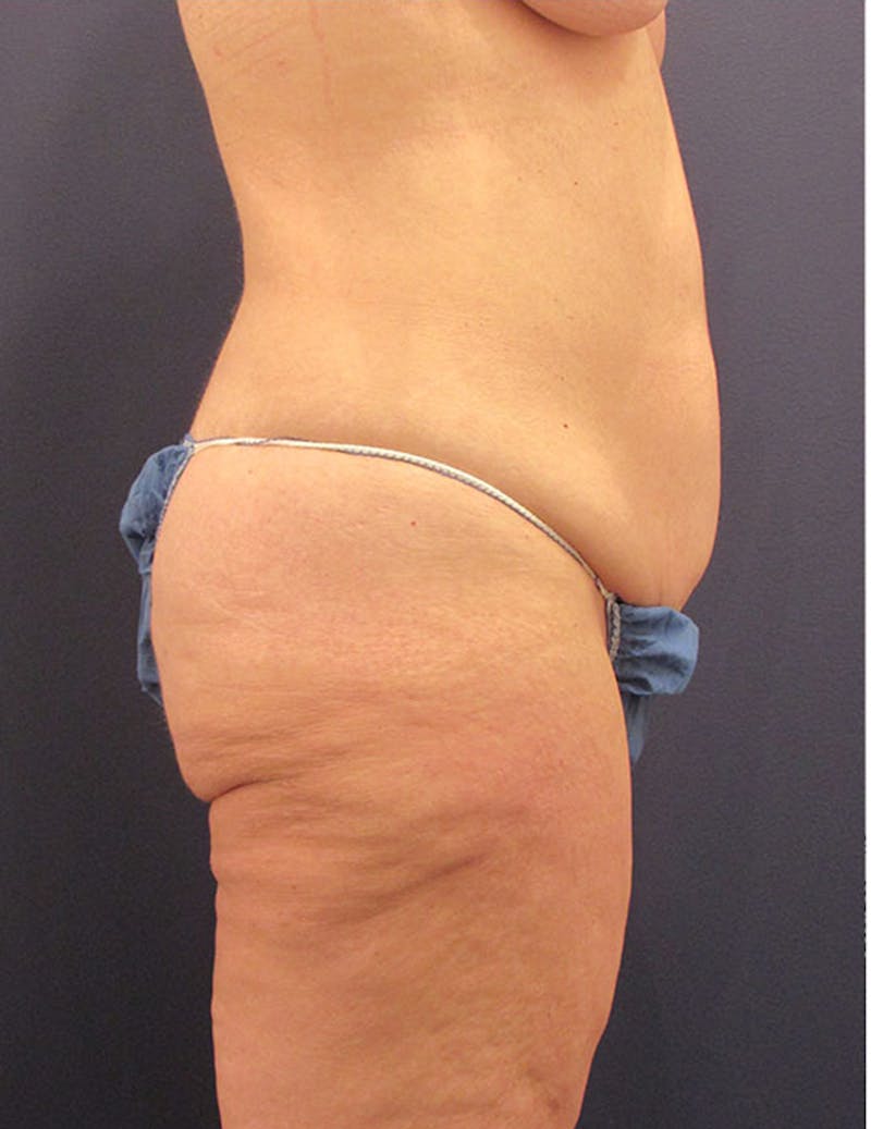 Tummy Tuck Before & After Gallery - Patient 174164465 - Image 5