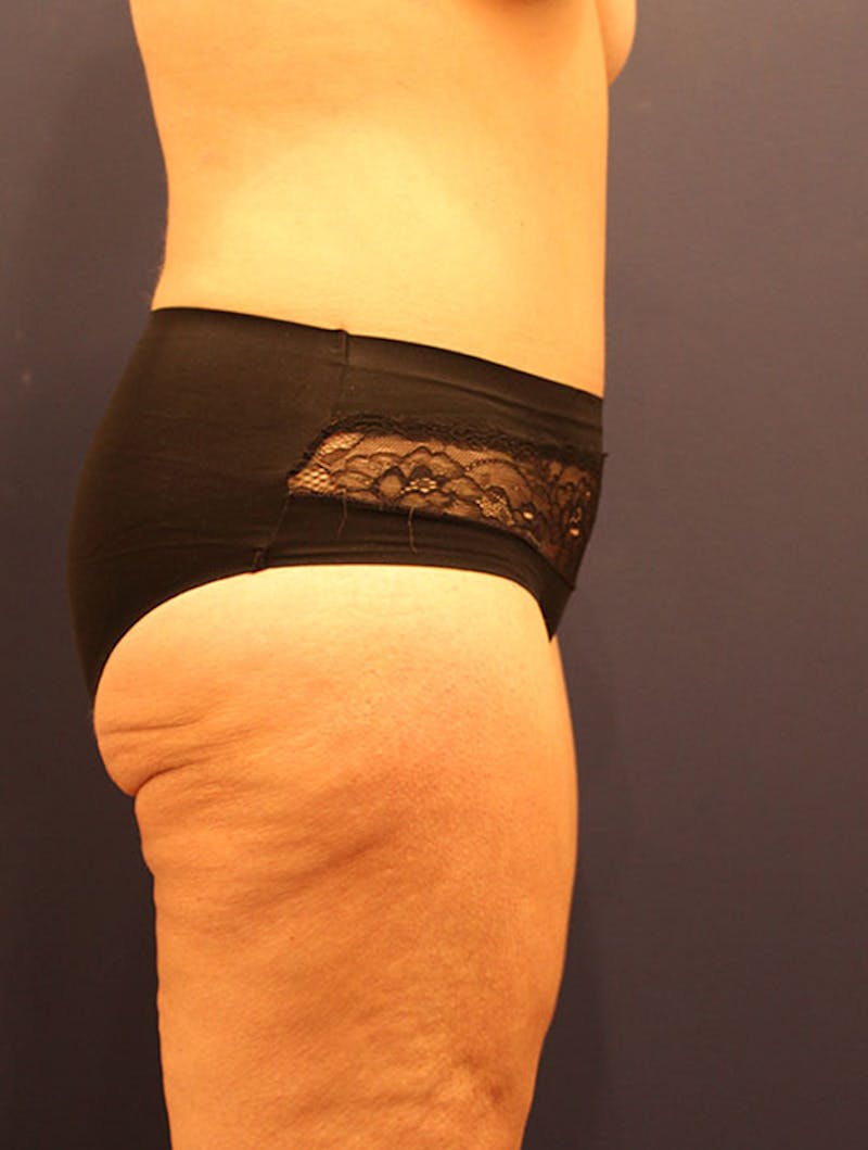 Tummy Tuck Before & After Gallery - Patient 174164465 - Image 6