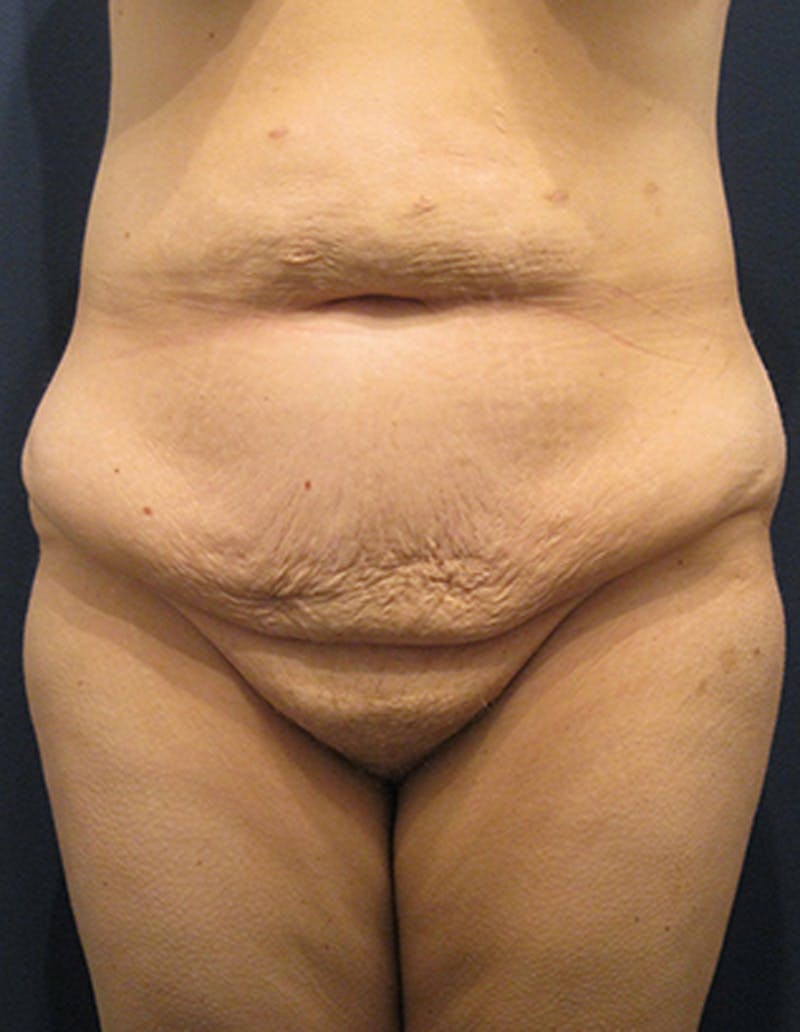 Tummy Tuck Before & After Gallery - Patient 174164470 - Image 1