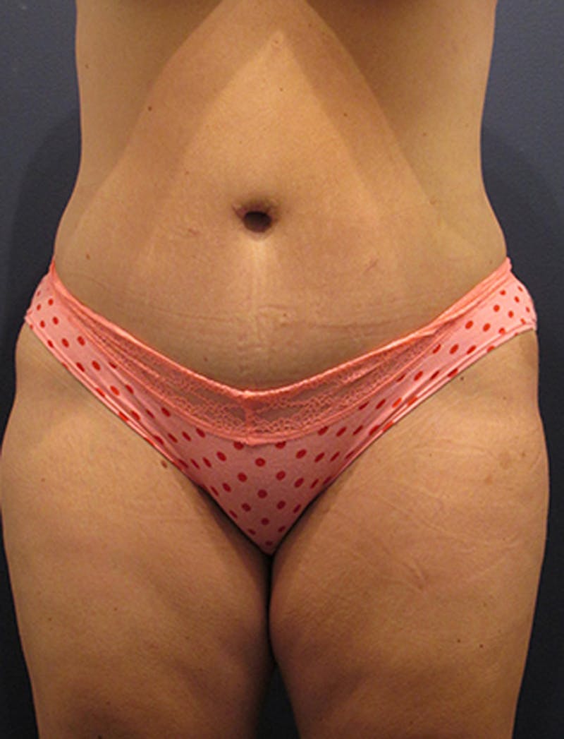 Tummy Tuck Before & After Gallery - Patient 174164470 - Image 2