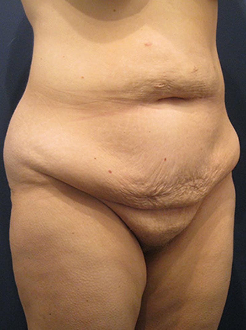 Tummy Tuck Before & After Gallery - Patient 174164470 - Image 3