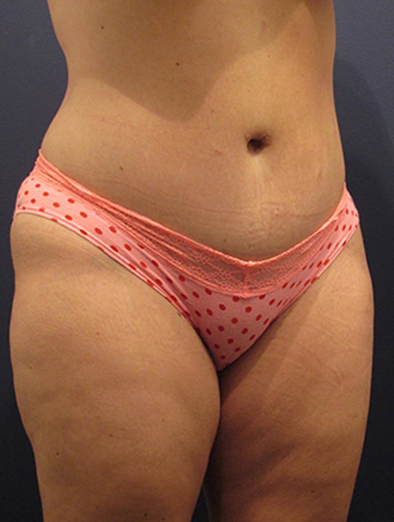 Tummy Tuck Before & After Gallery - Patient 174164470 - Image 4