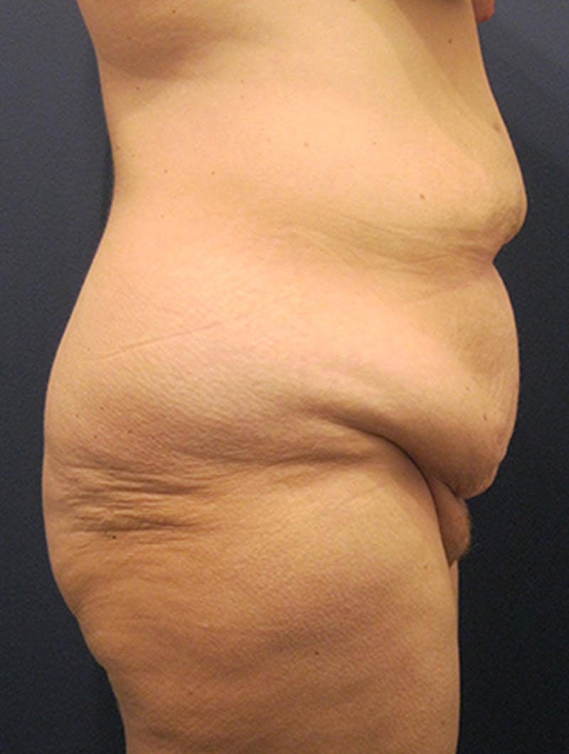 Tummy Tuck Before & After Gallery - Patient 174164470 - Image 5