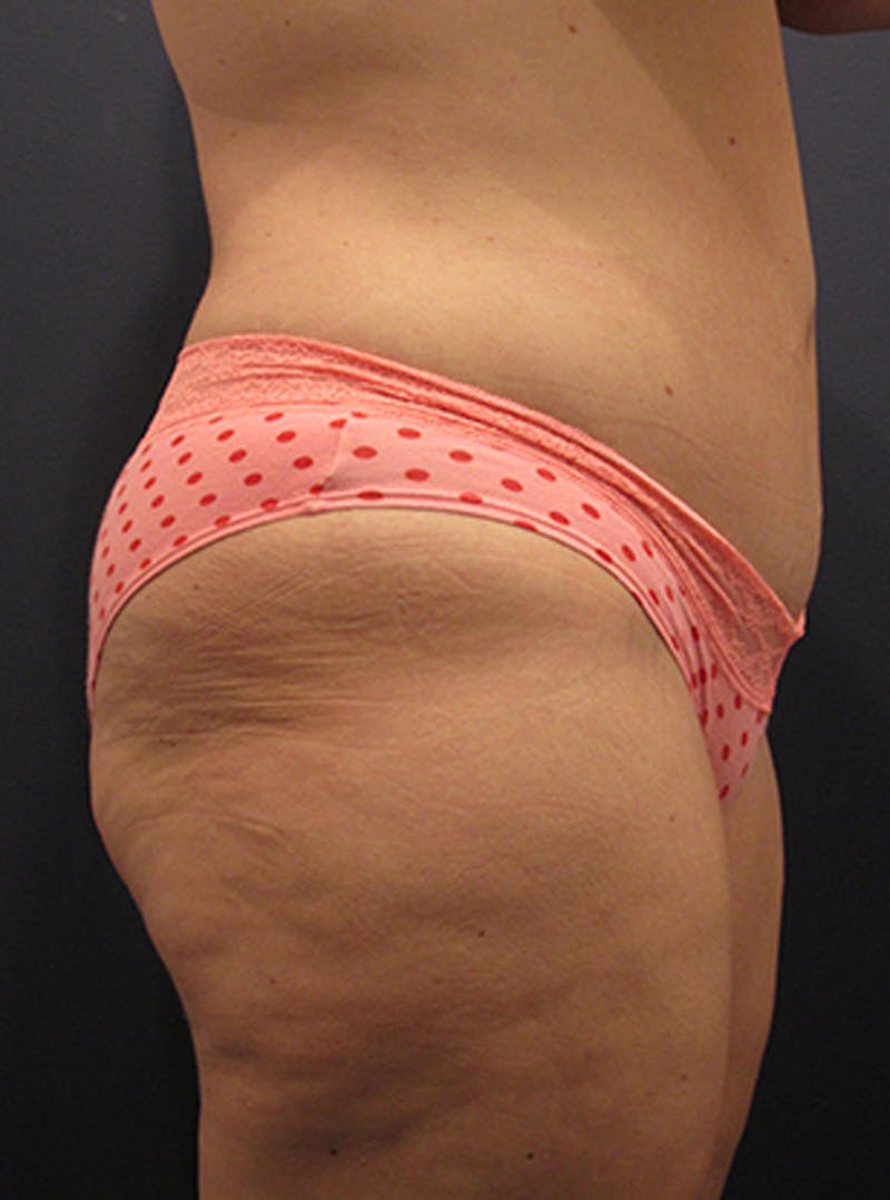 Tummy Tuck Before & After Gallery - Patient 174164470 - Image 6
