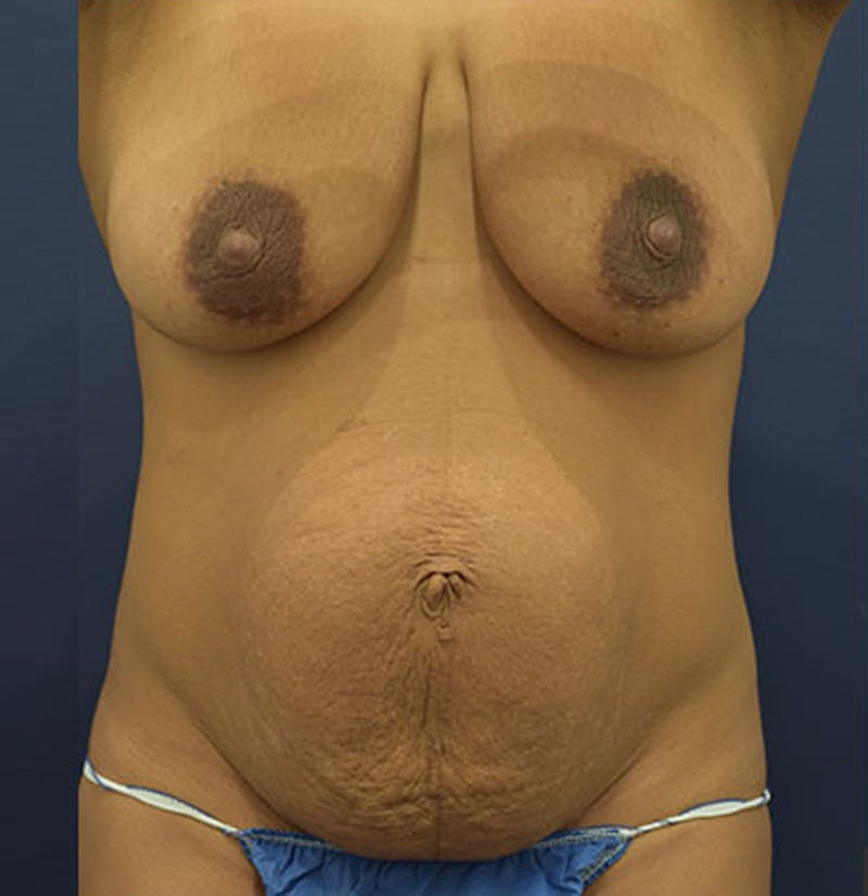 Tummy Tuck Before & After Gallery - Patient 174164472 - Image 1