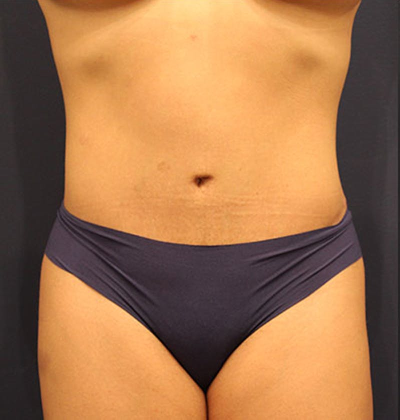 Tummy Tuck Before & After Gallery - Patient 174164472 - Image 2