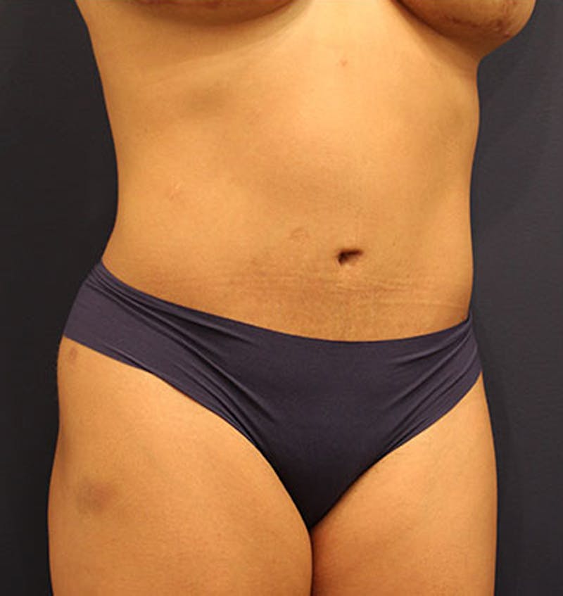 Tummy Tuck Before & After Gallery - Patient 174164472 - Image 4