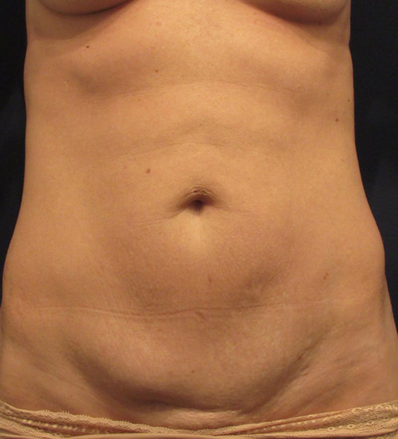 Tummy Tuck Before & After Gallery - Patient 174164481 - Image 1