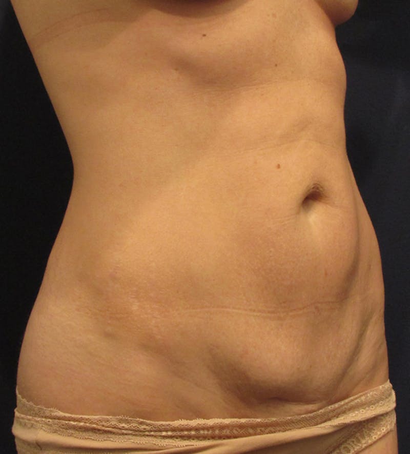 Tummy Tuck Before & After Gallery - Patient 174164481 - Image 3