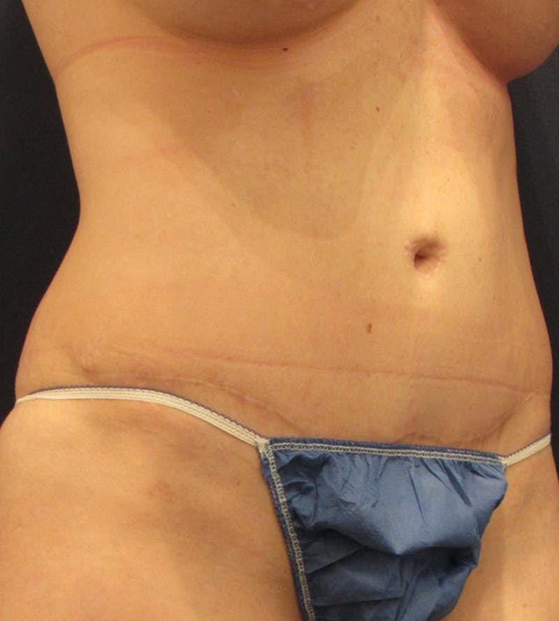 Tummy Tuck Before & After Gallery - Patient 174164481 - Image 4
