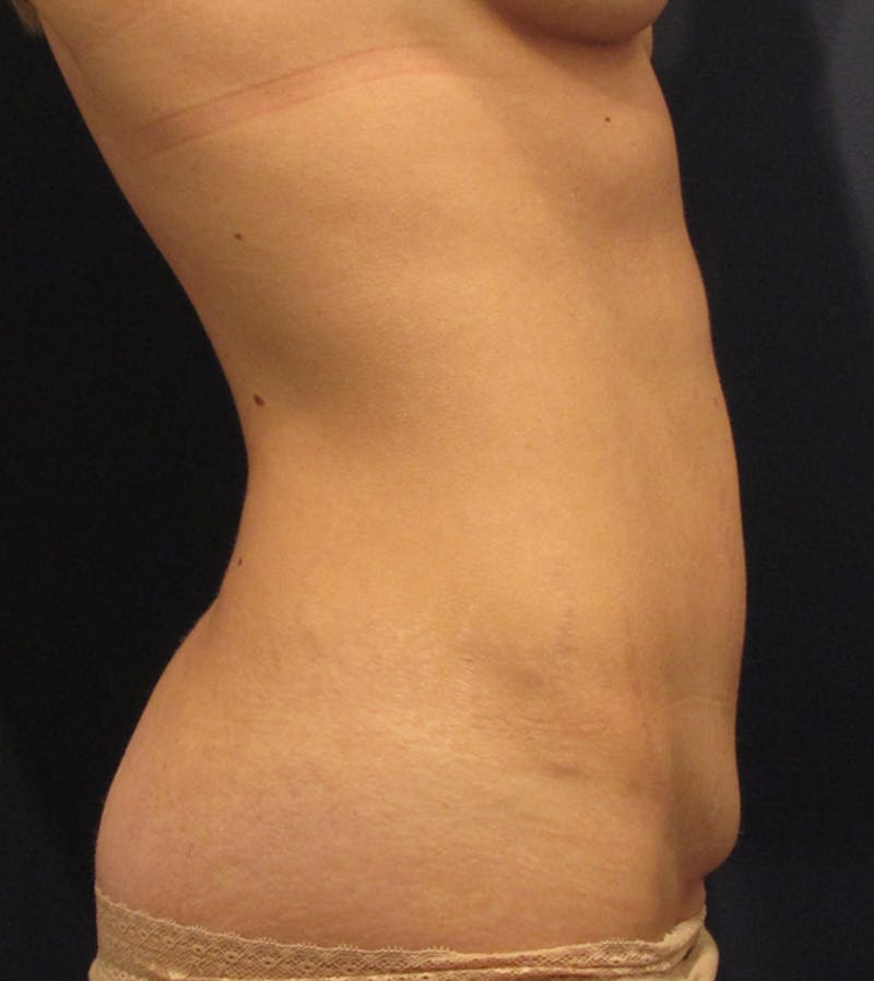 Tummy Tuck Before & After Gallery - Patient 174164481 - Image 5