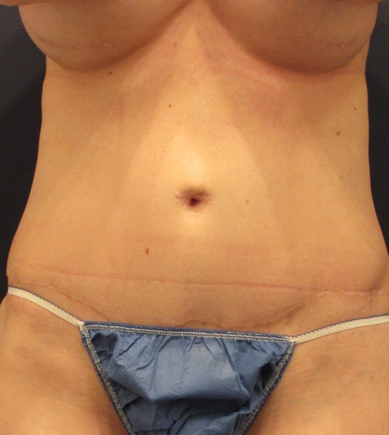 Tummy Tuck Before & After Gallery - Patient 174164481 - Image 2