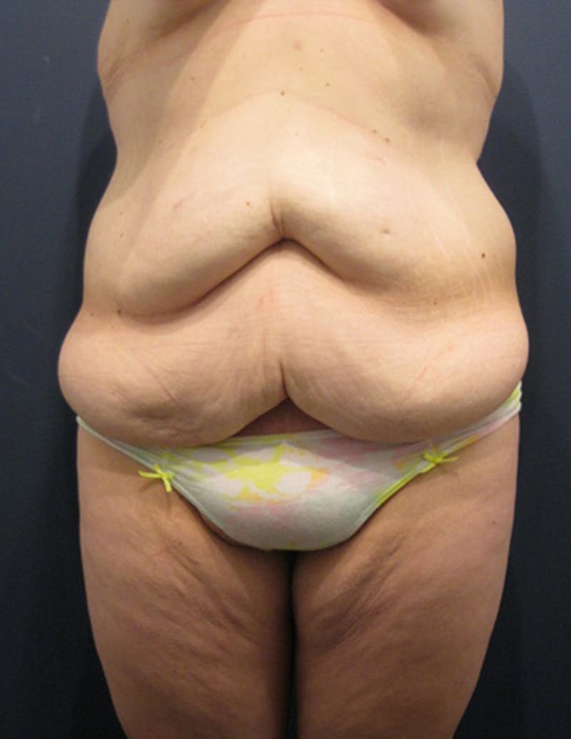 Tummy Tuck Before & After Gallery - Patient 174164491 - Image 1