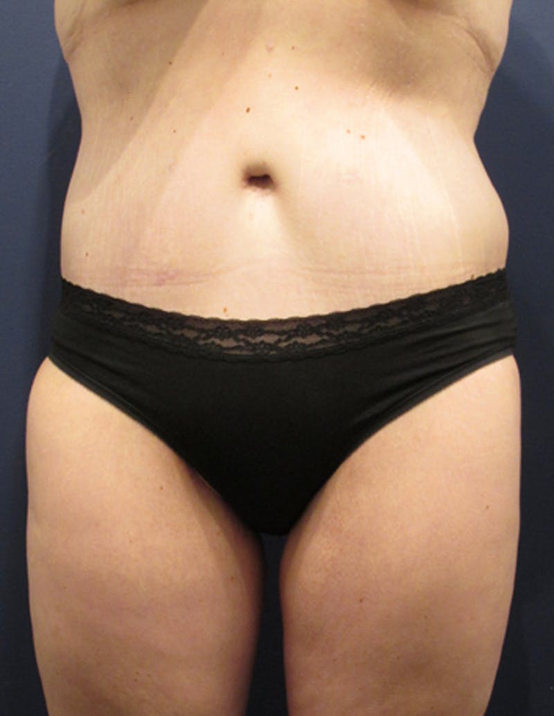 Tummy Tuck Before & After Gallery - Patient 174164491 - Image 2