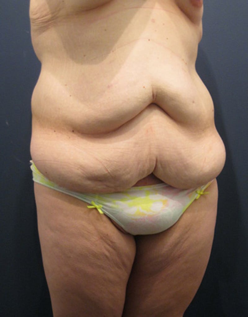 Tummy Tuck Before & After Gallery - Patient 174164491 - Image 3