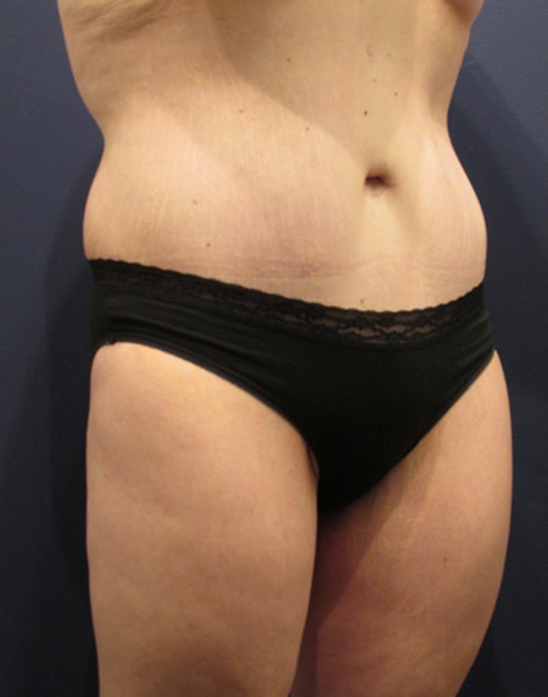 Tummy Tuck Before & After Gallery - Patient 174164491 - Image 4