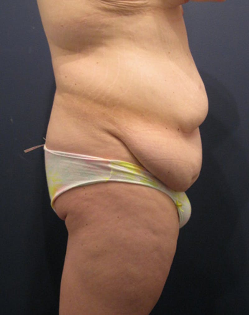 Tummy Tuck Before & After Gallery - Patient 174164491 - Image 5