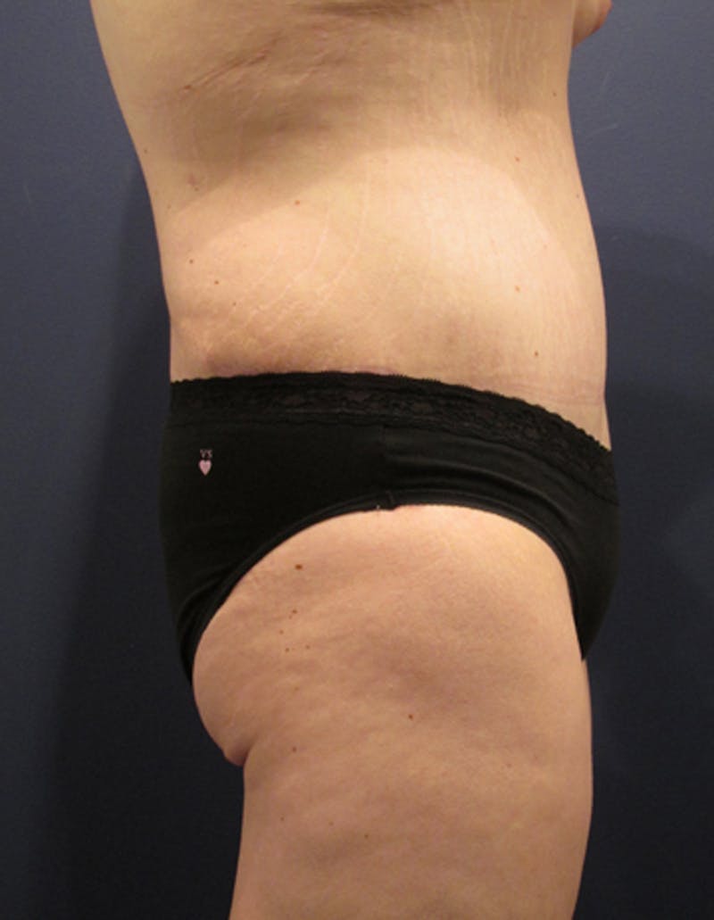 Tummy Tuck Before & After Gallery - Patient 174164491 - Image 6