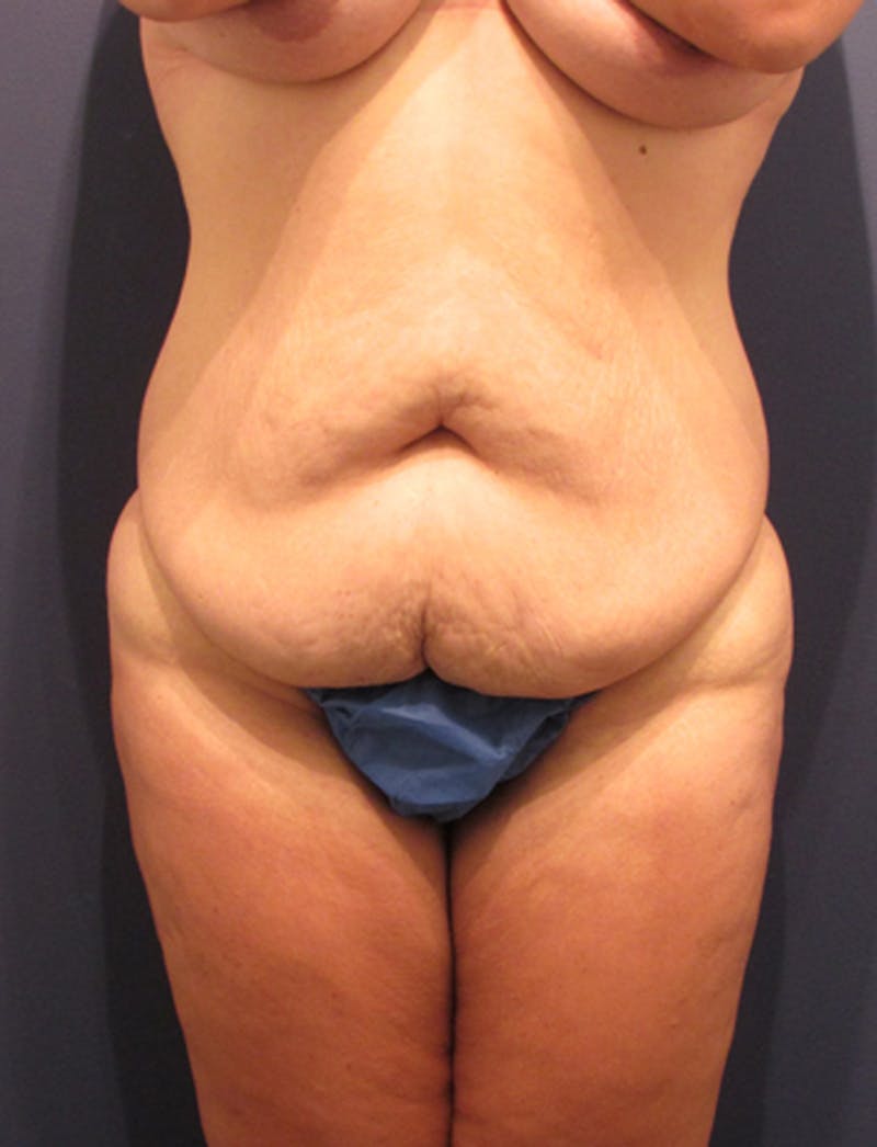 Tummy Tuck Before & After Gallery - Patient 174164495 - Image 1