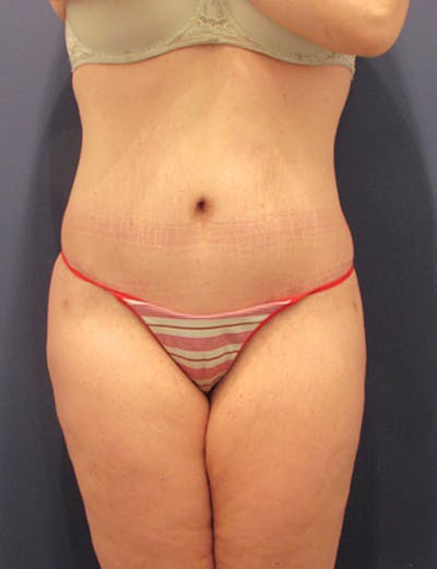 Tummy Tuck Before & After Gallery - Patient 174164495 - Image 2
