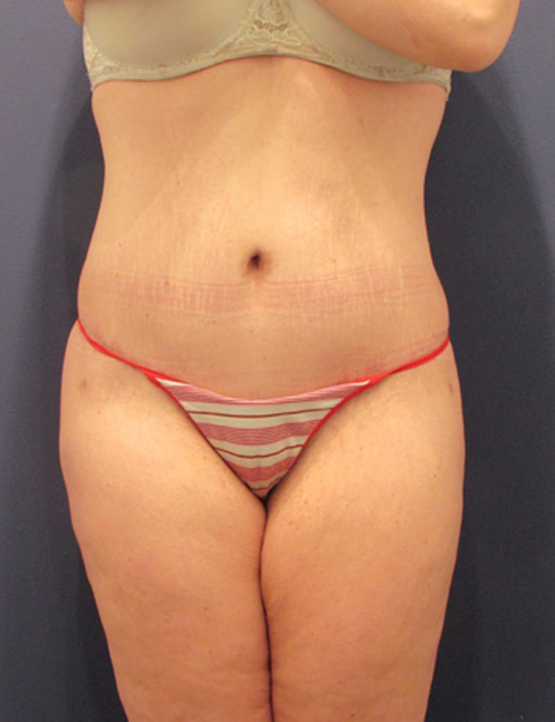 Tummy Tuck Before & After Gallery - Patient 174164495 - Image 2