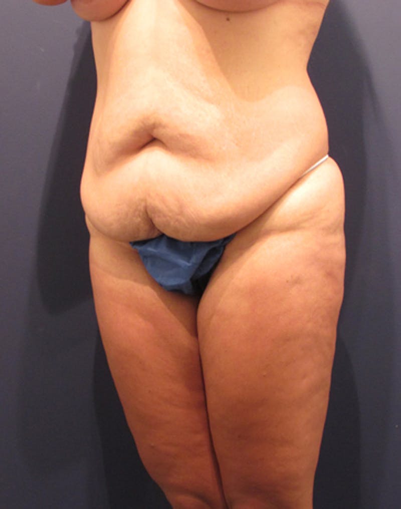 Tummy Tuck Before & After Gallery - Patient 174164495 - Image 3