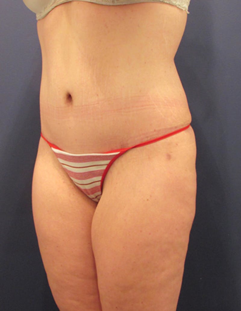 Tummy Tuck Before & After Gallery - Patient 174164495 - Image 4