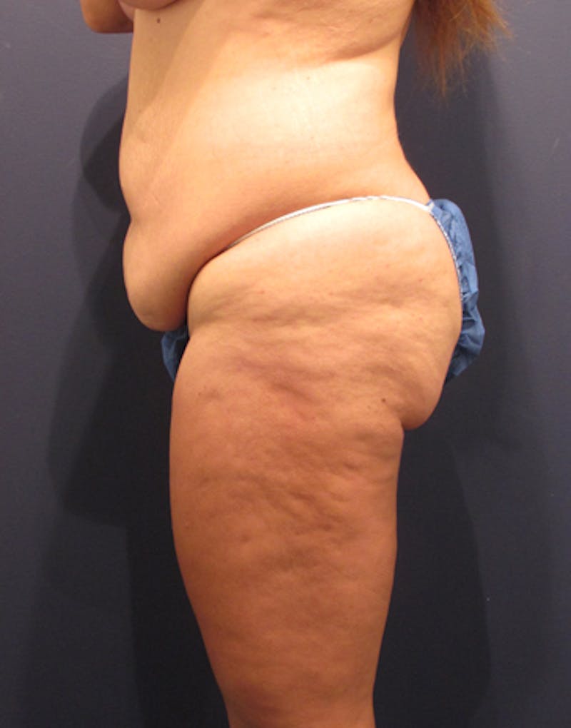 Tummy Tuck Before & After Gallery - Patient 174164495 - Image 5