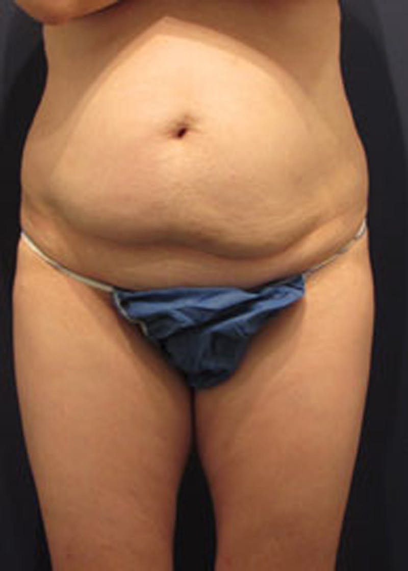 Tummy Tuck Before & After Gallery - Patient 174164498 - Image 1