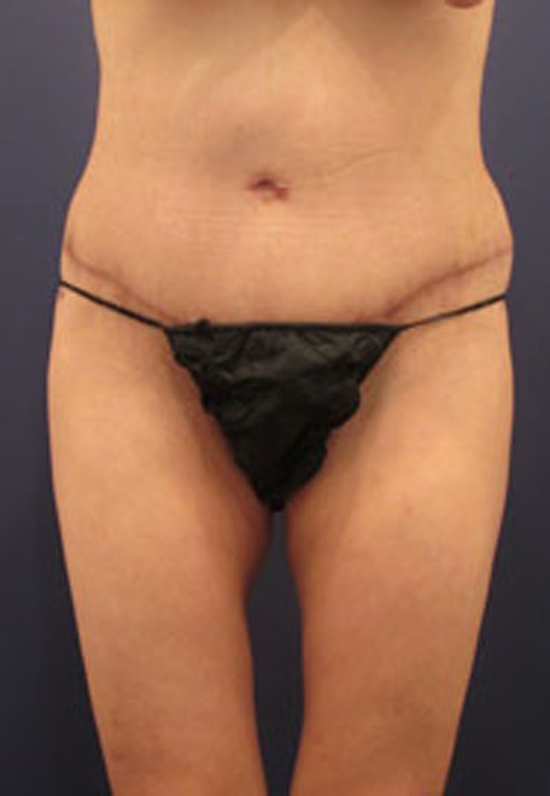 Tummy Tuck Before & After Gallery - Patient 174164498 - Image 2