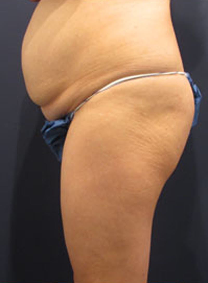 Tummy Tuck Before & After Gallery - Patient 174164498 - Image 5