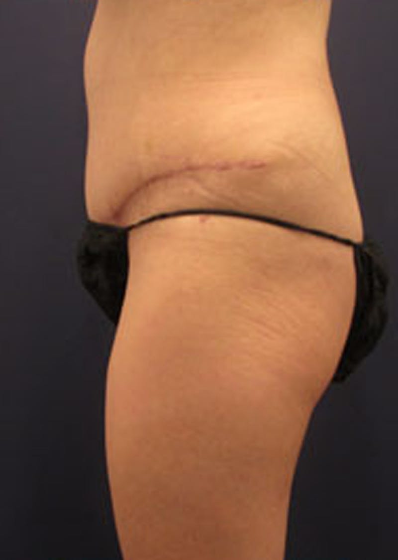 Tummy Tuck Before & After Gallery - Patient 174164498 - Image 6