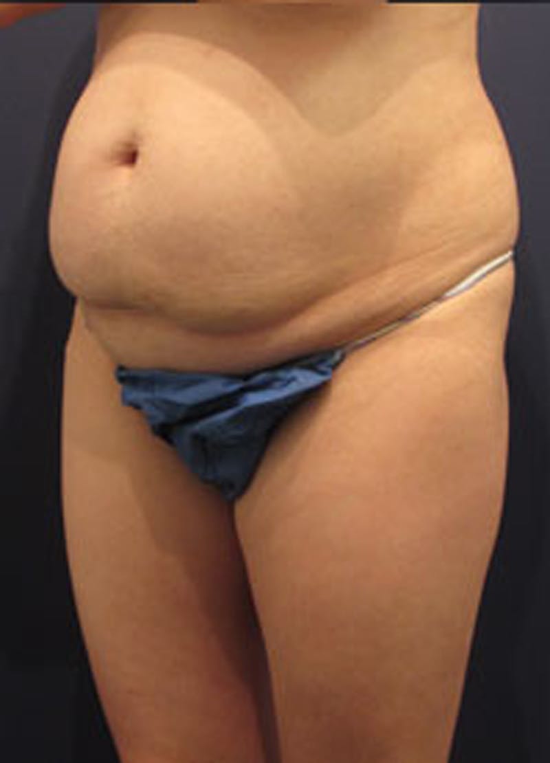 Tummy Tuck Before & After Gallery - Patient 174164498 - Image 3
