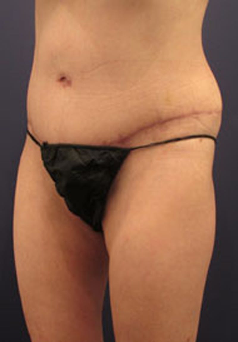 Tummy Tuck Before & After Gallery - Patient 174164498 - Image 4