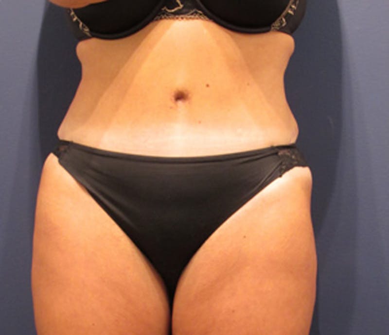 Tummy Tuck Before & After Gallery - Patient 174164504 - Image 2