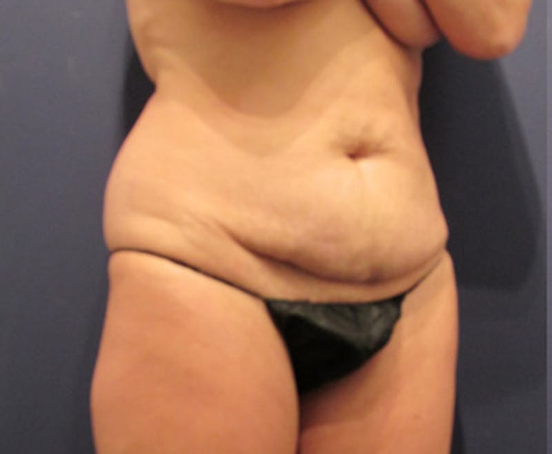 Tummy Tuck Before & After Gallery - Patient 174164504 - Image 3