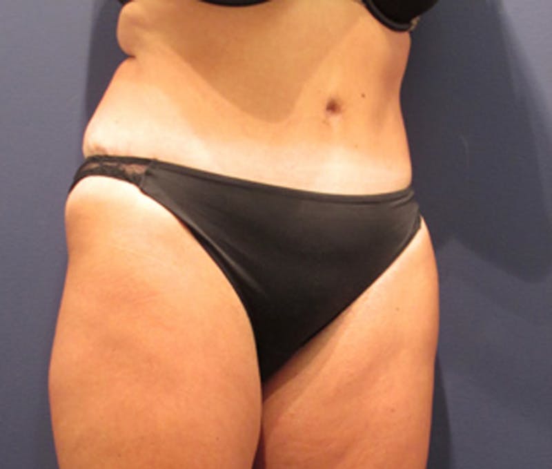Tummy Tuck Before & After Gallery - Patient 174164504 - Image 4