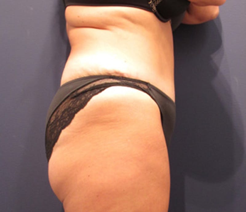 Tummy Tuck Before & After Gallery - Patient 174164504 - Image 6