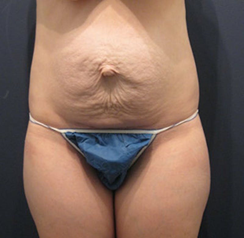 Tummy Tuck Before & After Gallery - Patient 174164506 - Image 1