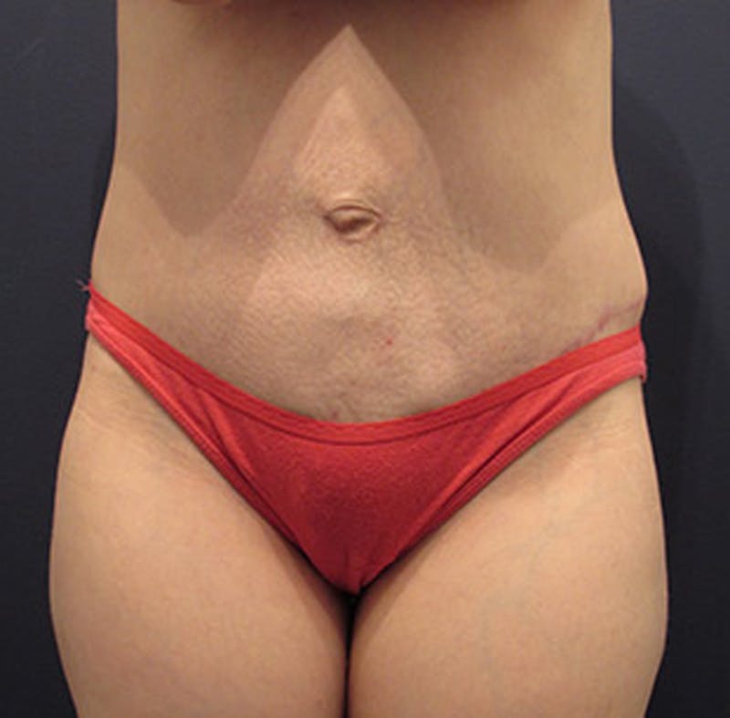 Tummy Tuck Before & After Gallery - Patient 174164506 - Image 2