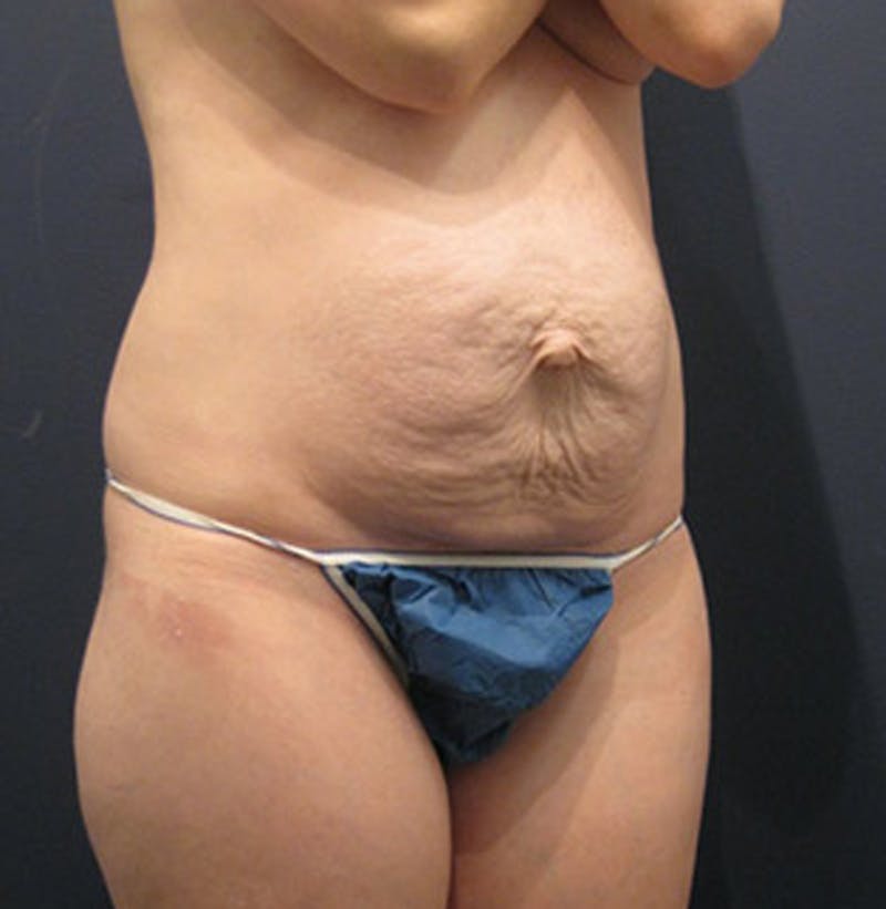 Tummy Tuck Before & After Gallery - Patient 174164506 - Image 3