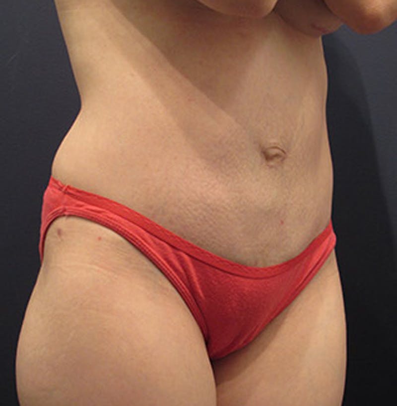 Tummy Tuck Before & After Gallery - Patient 174164506 - Image 4