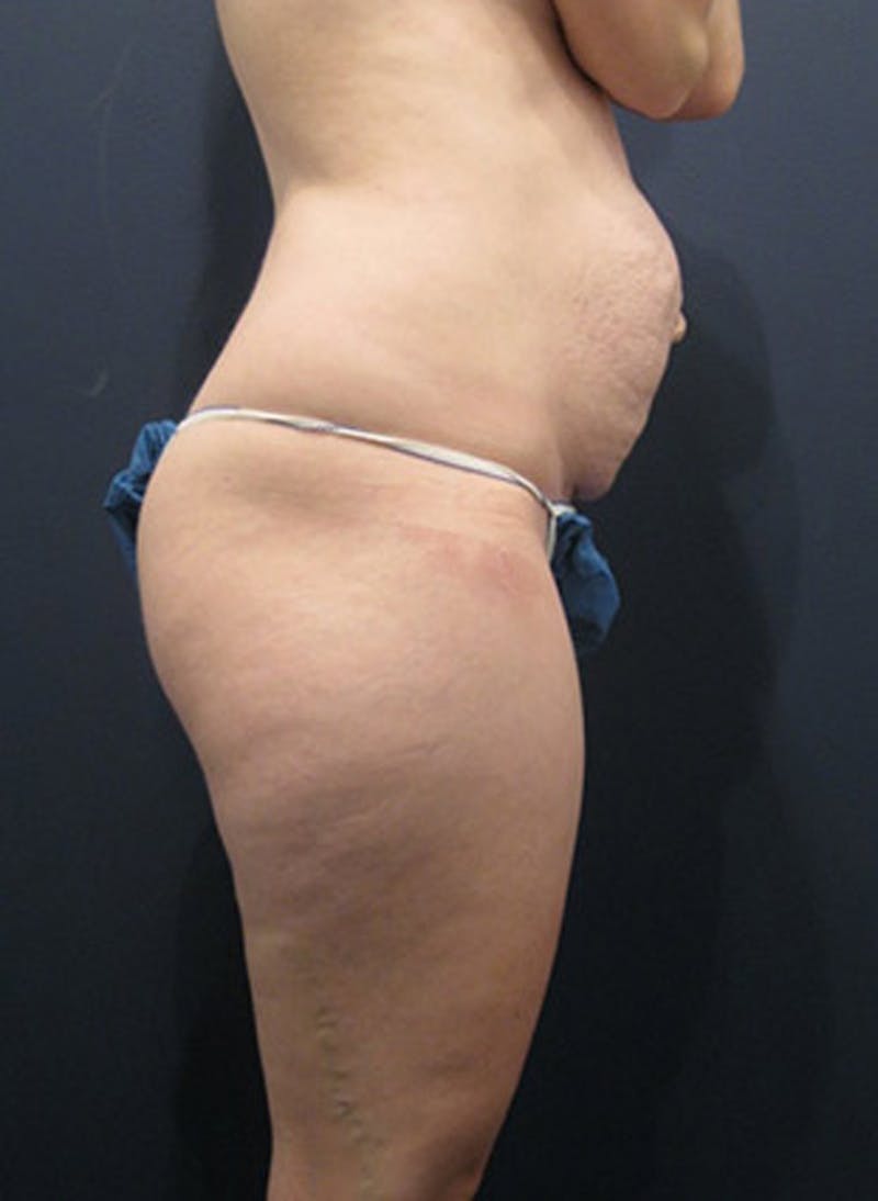 Tummy Tuck Before & After Gallery - Patient 174164506 - Image 5