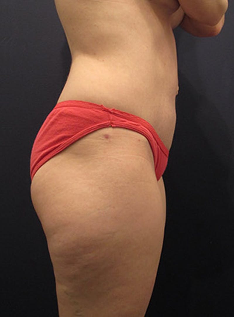 Tummy Tuck Before & After Gallery - Patient 174164506 - Image 6